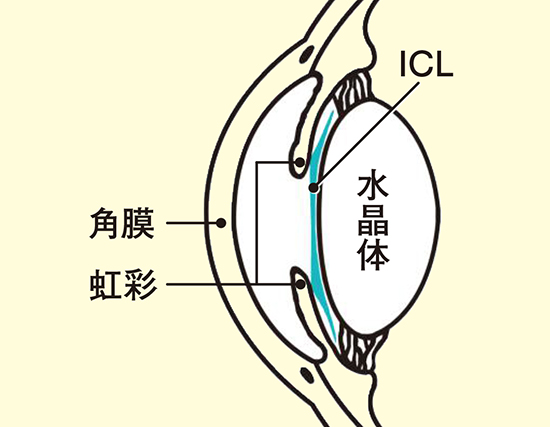 もう若くないから」とあきらめないで！最新技術で選択肢が広がる「視力