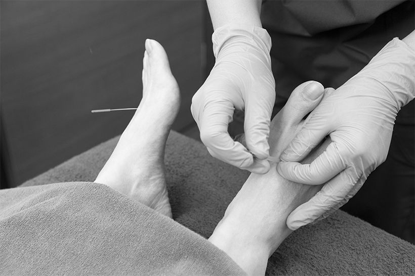 足の甲にある太衝（たいしょう）に鍼を打つ。肝の気を下ろす定石の経穴だ。