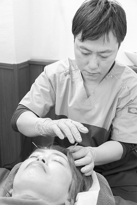 めまいへの緩和効果がある頭臨泣（あたまりんきゅう）など頭部の経穴も鍼で刺激する。