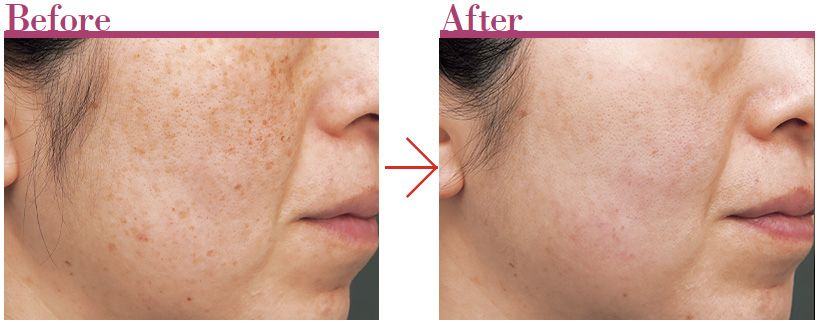 ルビーフラクショナルの治療を3回行った40代女性の症例。大小無数のシミ、くすみが一掃、晴れやかな印象に。