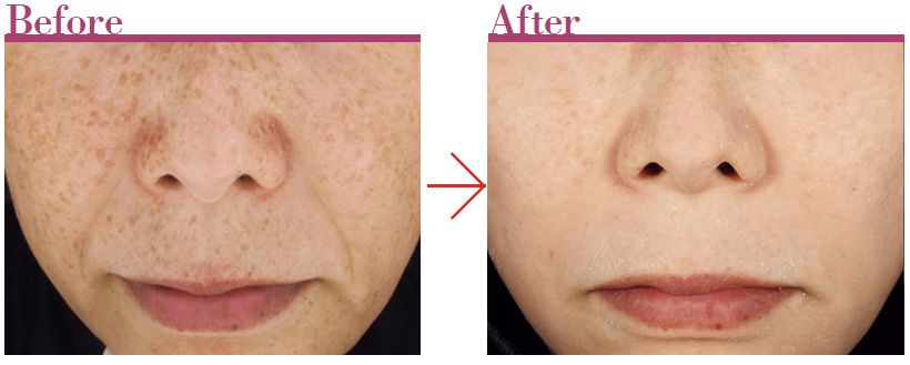 ゼオスキンヘルスを用い18週間の集中プログラム（セラピューティック）で治療を行った50代女性。顔全体のシミ、シワが著しく改善した。