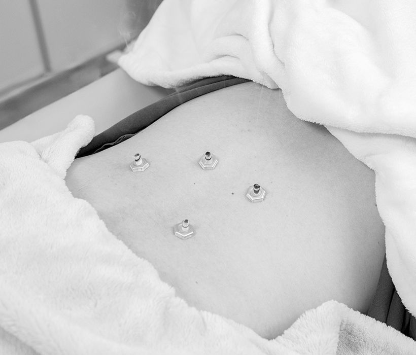 鍼の施術後に血の巡りをよくすることが得意な灸を行うことも多い。