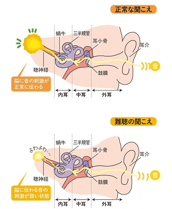 イラスト上段は、音の刺激が脳にきちんと伝わり、正常に聞こえている状態。一方、下段は脳に伝わる刺激が弱く、聞こえが悪い状態。この状態に慣れてしまった脳が「難聴の脳」。