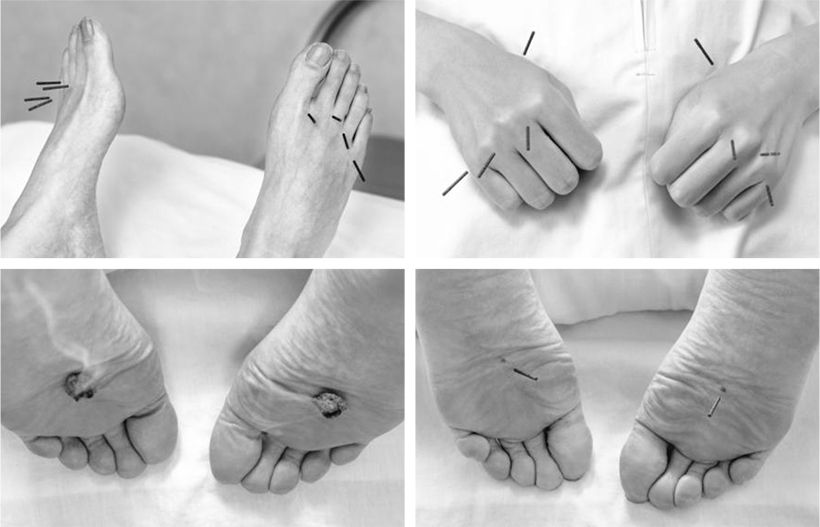 強いしびれが出る手足には八邪（上右）と八風（上左）に鍼を。足底のしびれには湧泉に鍼（下右）と知熱灸（下左）を施術。緩和ケアの施術法を参考にした。