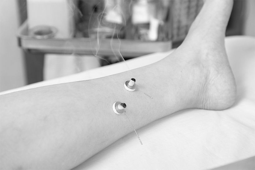 6本の経絡の走行に沿って見つけ出したしびれの境界点に鍼灸を施す。施術回数を重ねると週単位でしびれの境界点が変わっていく。