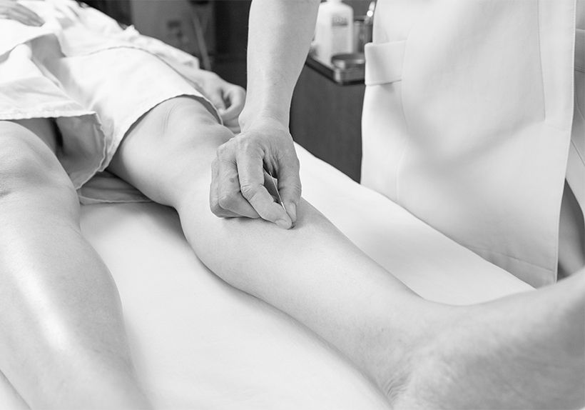 鍼の柄を使って5ミリ間隔で脚を突き、しびれの境界点を探す。