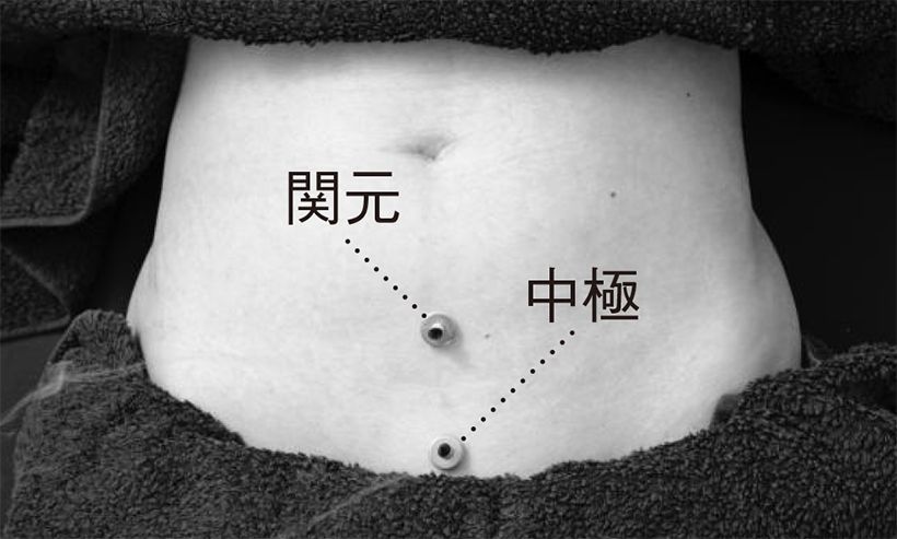 セルフ灸 過活動膀胱の症状を軽減する