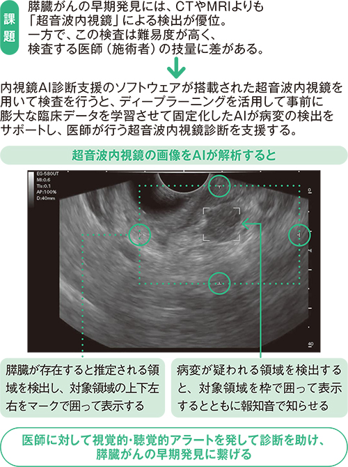 がんの早期発見に役立つ「内視鏡AI技術」。高難度の検査への活用で