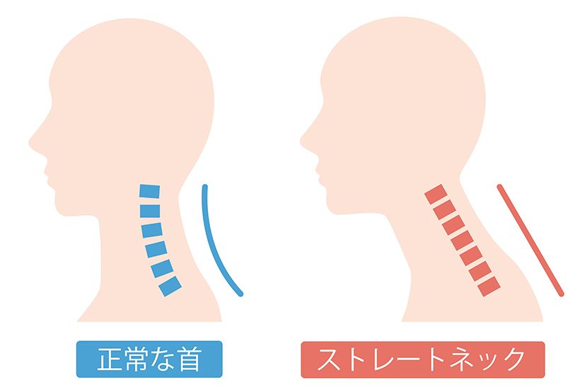 正常な頚椎はゆるやかに前方へカーブすることで、頭の重さを支えている。一方、ストレートネックでは頚椎のカーブがなくなり、重い頭部を支える首や肩に負担がかかる。