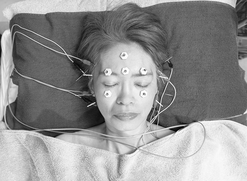 鍼通電療法を行いながら要所の経穴にお灸をする。