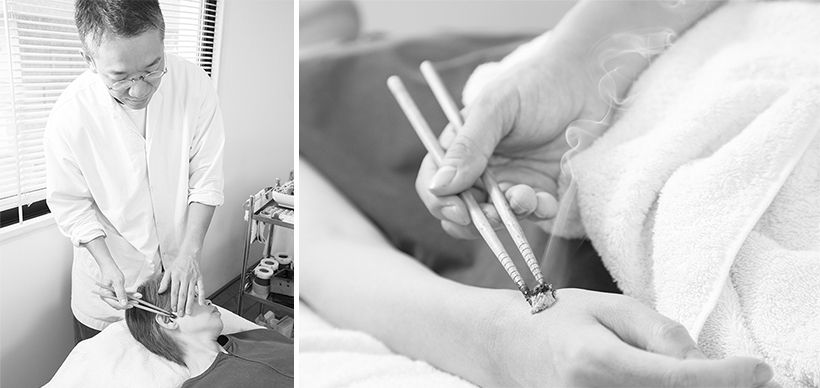 手にある合谷（ごうこく）（右）と耳の前にある聴宮（ちょうきゅう）（左）の経穴を知熱灸で温める。心地よい温度を保ち、熱くなる前に灸を取り除く。