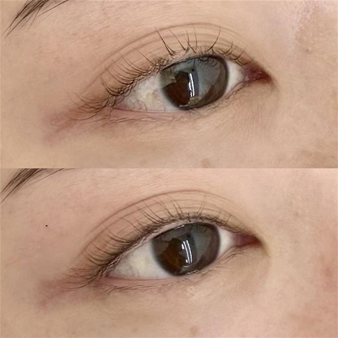 上が施術前、下が施術後。目の輪郭がくっきりすることで、ぼんやり感が払拭されて目が大きく見えます。