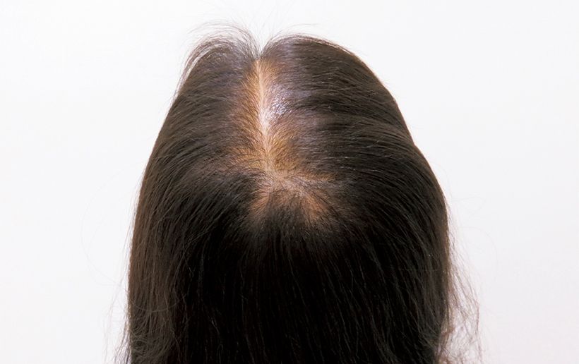 治療前の頭頂部。髪の量が少なく全体的にボリュームが不足しがちで、髪の分け目から頭皮が透けて見えている。頭皮のベタつきや、他人の視線が気になるといったお悩みも。