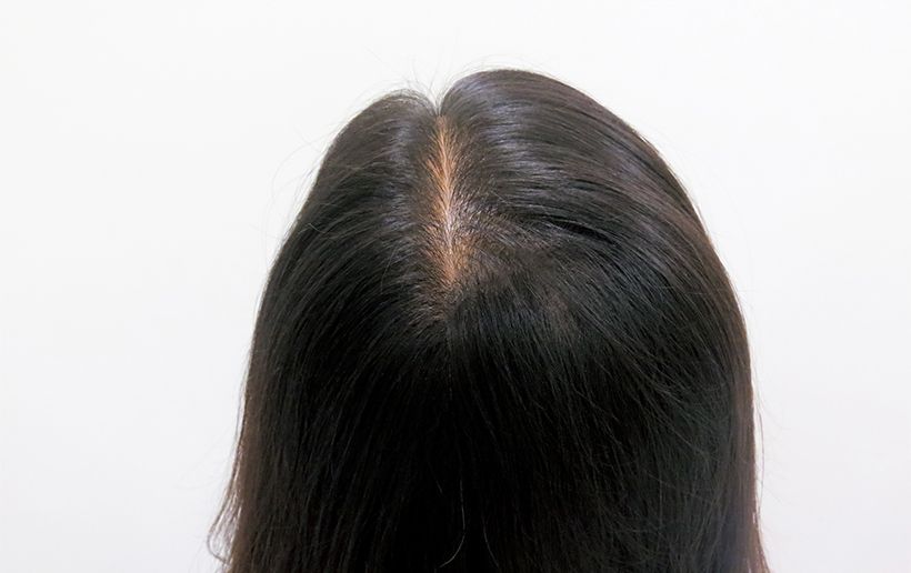 外用薬による治療を続け、通院後12か月経過した状態がこちら。全体的に髪の量が増えふさふさとした印象に。透けて見えていた頭皮も目立たなくなっている。