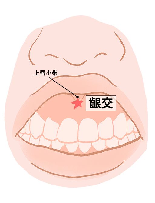 齦交（ぎんこう）：督脈のツボ
