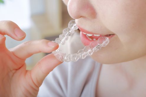 「思ったより大変」との声もあるマウスピース矯正の実際について歯科医師が解説