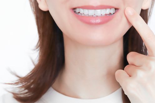 後戻りを防ぐリテーナーの正しい装着方法を解説。矯正治療の真の「ゴール」とは？