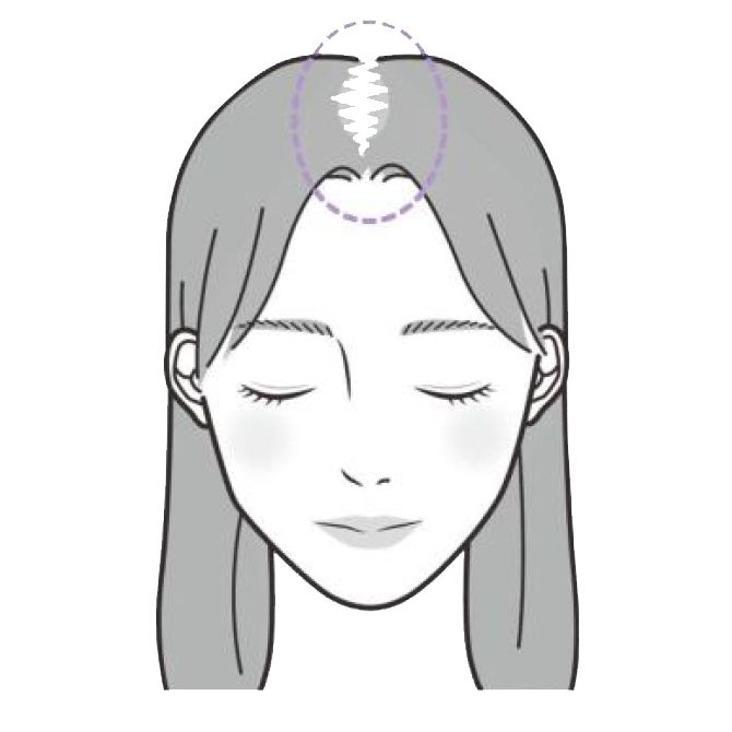 ［びまん性脱毛症］