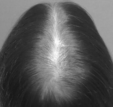 ［分け目の広がり］before