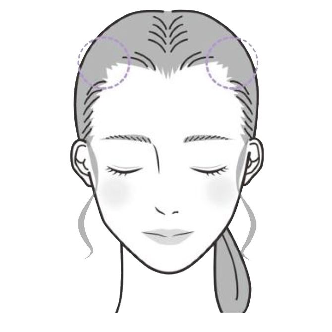 ［牽引性（けんいんせい）脱毛症］