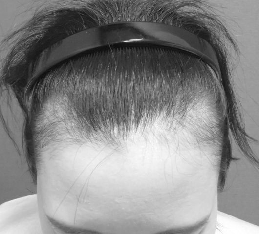 ［生え際・前髪が薄い］before