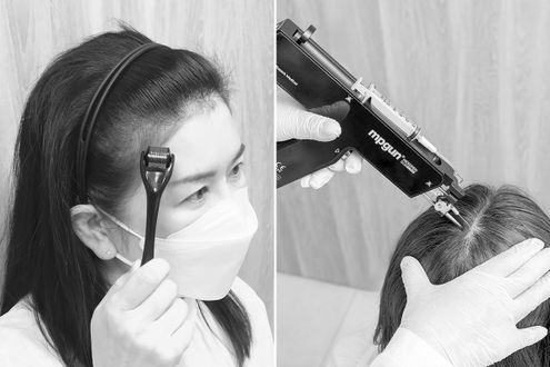 更年期からの発毛治療の新時代。ライフスタイルに合わせた新たな選択肢が登場